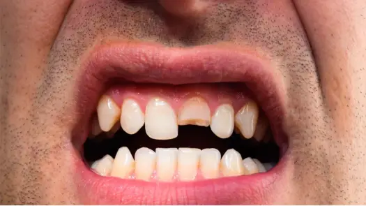 Złamany ząb - korzeń został. Czy da się go uratować?
