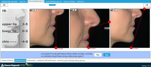 Klikająca szczęka - Kiedy to normalne, a kiedy do dentysty?