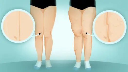 Lipodemia test - Czy istnieje jeden? Prawda o diagnozie