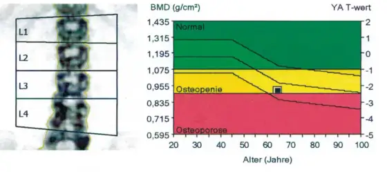 Osteoporose-Wertetabelle - So deuten Sie T-Score & Z-Score richtig