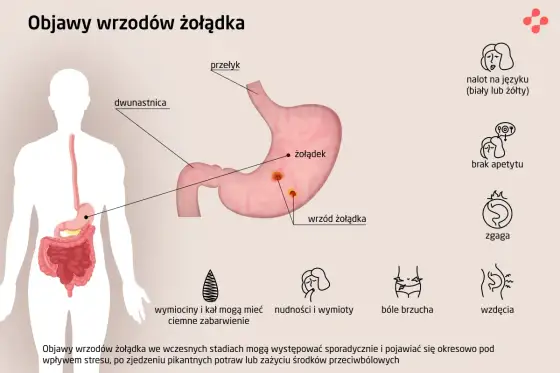 Wrzody żołądka - objawy, przyczyny i leczenie. Czy to H. pylori?