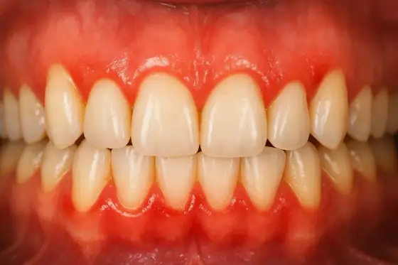 Dziąsła w ciąży - kiedy krwawienie wymaga dentysty?