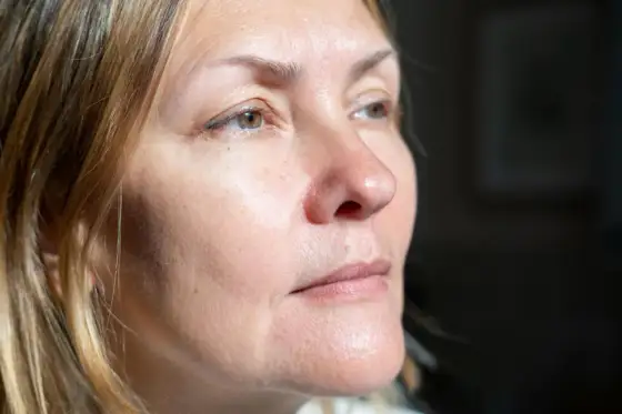 Twarde policzki po wolumetrii - kiedy to norma, a kiedy nie?