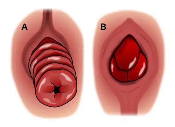 Descente d’organe chez l’homme - reconnaître un prolapsus rectal