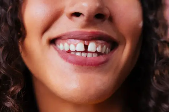 Diastema - Przerwa między jedynkami - Kiedy leczyć, kiedy nie?
