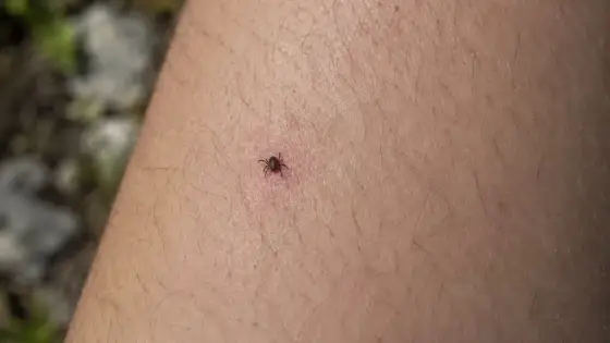 Cómo quitar una garrapata en niños sin apretarla