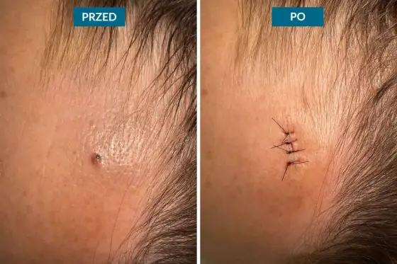 Usuwanie pieprzyków z twarzy - Laser czy chirurgia?