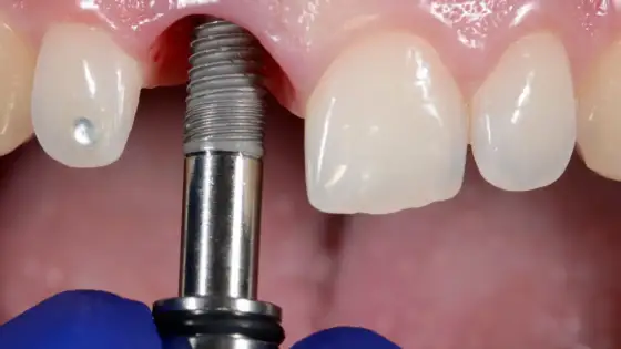 Implant zęba - Przewodnik: zabieg, koszty, gojenie i pielęgnacja