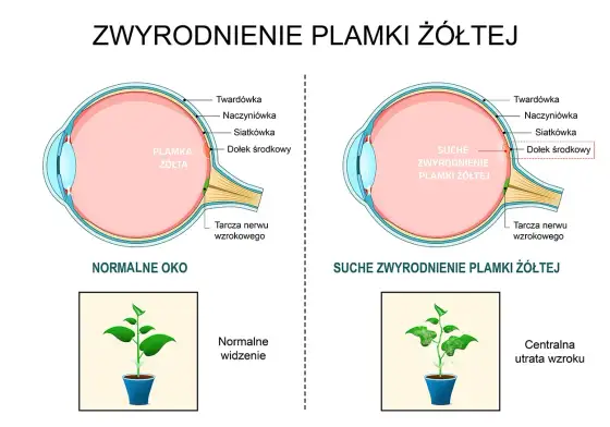 Suche oko - powikłania, objawy, leczenie. Chroń swój wzrok!