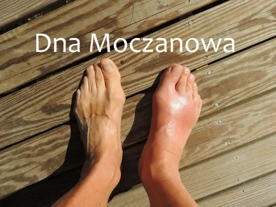 Ból pięty przy dnie moczanowej - jak odróżnić go od przeciążenia?
