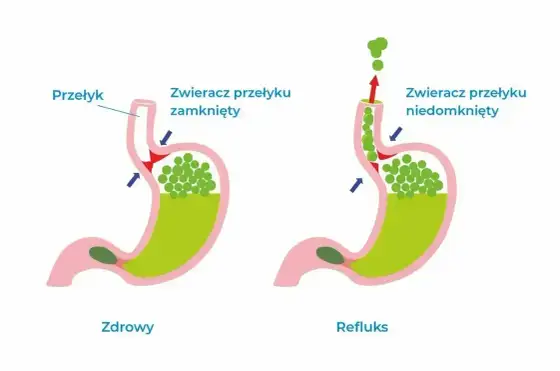 Gula w gardle - domowe sposoby i sygnały alarmowe