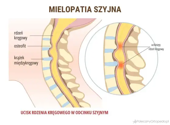 Drętwienie barku - nerw, szyja czy staw? Rozwiąż zagadkę!