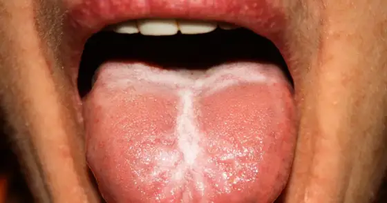 Leukoplakia - Biała plama w ustach? Sprawdź, kiedy to groźne!
