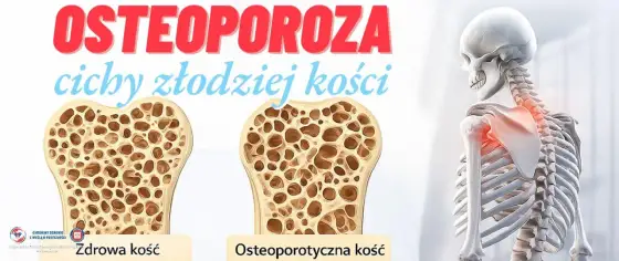 Osteoporoza - jak ją rozpoznać i chronić kości na co dzień