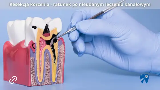 Resekcja wierzchołka korzenia – Jak uratować ząb po leczeniu kanałowym?