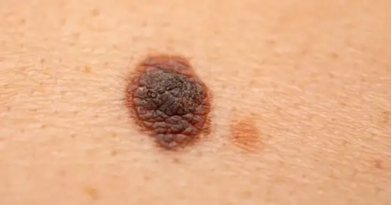 Swędzące znamię - Czy to czerniak? Kiedy iść do dermatologa?