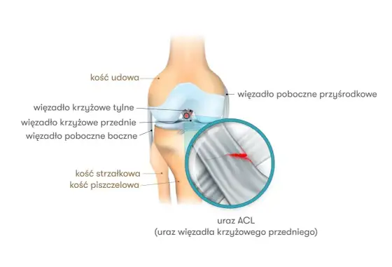 Uraz więzadła kolana - objawy, leczenie, powrót do formy