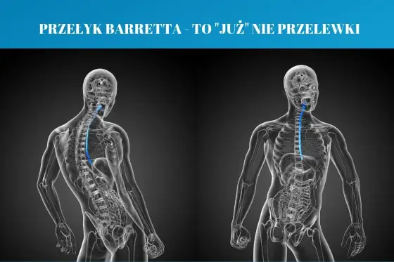 Przełyk Barretta - czy na pewno wiesz, co oznacza?