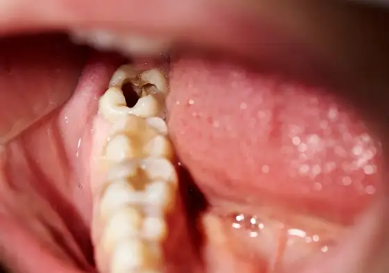 Uzębienie - Jak dbać? Co je niszczy? Kiedy do dentysty?