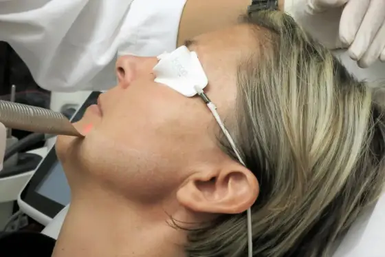 Endolifting twarzy - laser czy RF i czego się spodziewać?