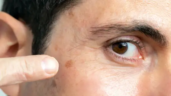 Lunares en la cara: ¿cuándo preocuparse y cómo actuar?