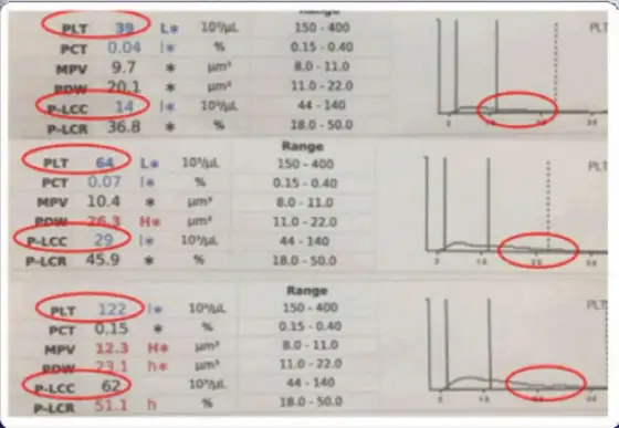 P-LCR w morfologii krwi - co oznacza ten wynik?