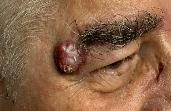 Nowotwór pierwotny - Co to znaczy? Zrozum diagnozę!