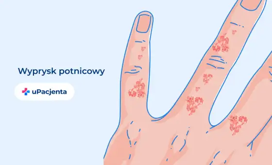 Egzema - Wyleczalna czy kontrolowalna? Sprawdź, co działa!