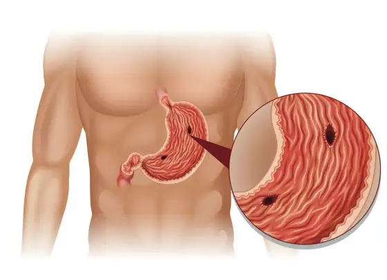 Helicid - kiedy pomaga na refluks, wrzody i H. pylori?