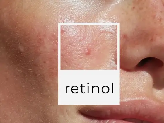 Retinol - jak zacząć, by skóra go pokochała?