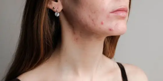 Antybiotyk na trądzik - Kiedy ma sens i jak go stosować?