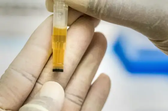 Leukocyty w moczu - co oznaczają i kiedy trzeba działać