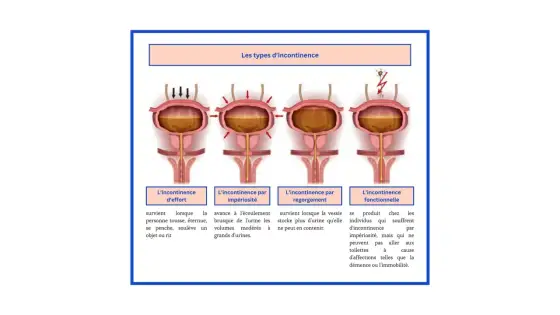 Fuite d’urine en éternuant ? Comprendre l’incontinence d’effort