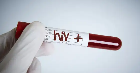 HIV - czy to wciąż wyrok? Objawy, test, leczenie, profilaktyka