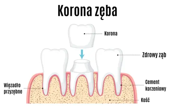 Ile trwa założenie korony na zęba? Czas leczenia i wizyt
