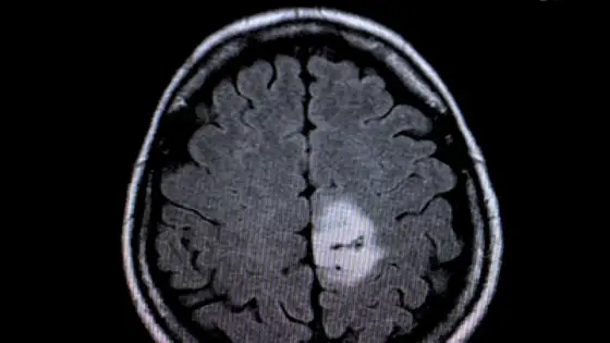 Hirntumor: Erste Anzeichen erkennen – Wann handeln?