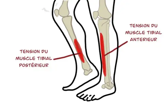 Tibia douloureux en courant - Comprendre et reprendre sans douleur