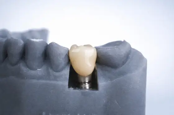 Implant zęba 6 - ile naprawdę kosztuje? Uniknij ukrytych opłat.