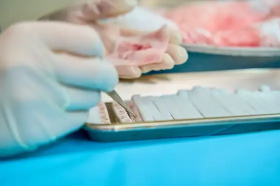 Czy biopsja jest bezpieczna - Dowiedz się, jak uniknąć powikłań