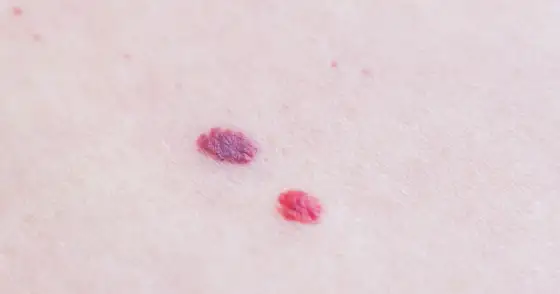Czerwone pieprzyki - jak je rozpoznać i kiedy iść do dermatologa