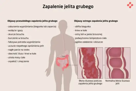 WZJG - objawy, leczenie i życie z chorobą. Co musisz wiedzieć?
