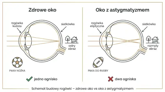 Cylinder w soczewkach - Klucz do ostrego widzenia przy astygmatyzmie