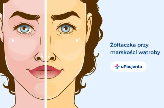 Marskość wątroby - Jak wygląda ostatni etap i kiedy reagować?