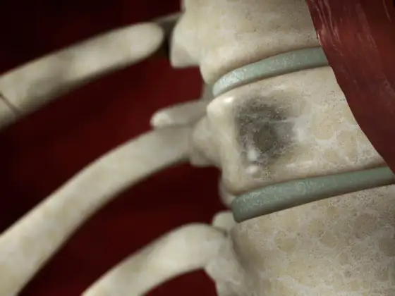 Multiples Myelom - Symptome, Diagnose & Therapie verstehen