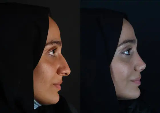 Rhinoplastyka nosa - techniki, gojenie i realne efekty
