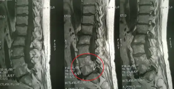 Dyskopatia wielopoziomowa - Jak czytać MRI i kiedy do lekarza?