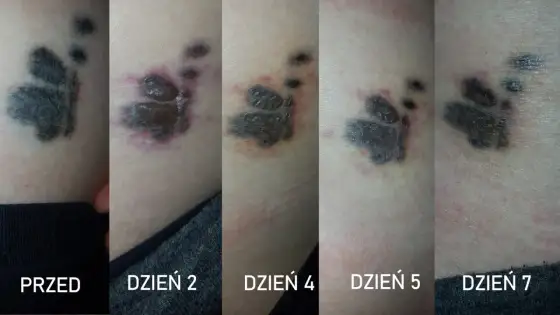 Gojenie po laserowym usuwaniu tatuażu - co jest normalne?