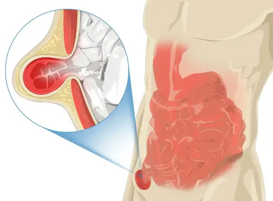 Pubis gonflé - Quand s'inquiéter et que faire ?