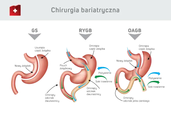 Operacja bariatryczna - kiedy ma sens i jakie są metody?