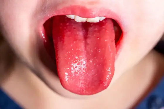 Choroba Kawasakiego u dzieci - objawy, diagnoza i leczenie